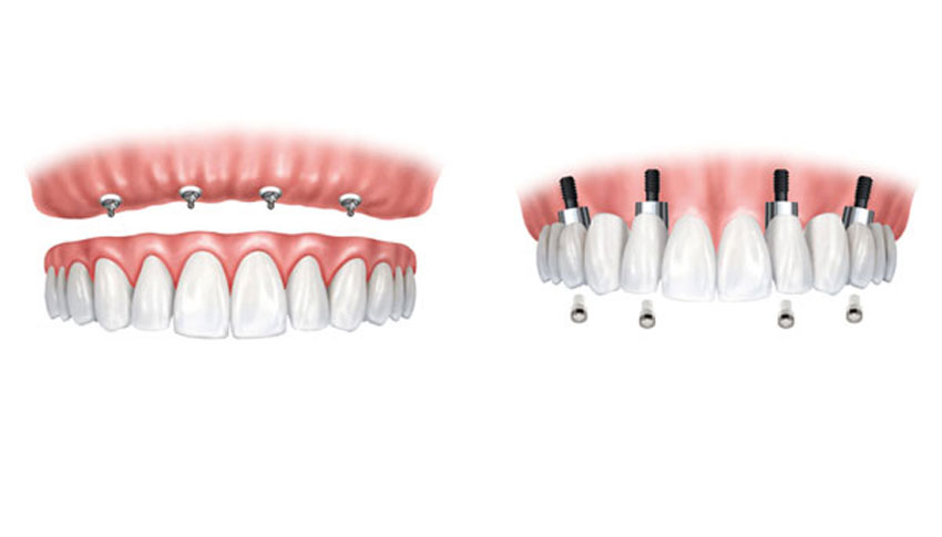 Fixed & Removable Dentures